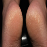 Home-remedies-for-dry-feet-and-cracked-heels-600×359-1